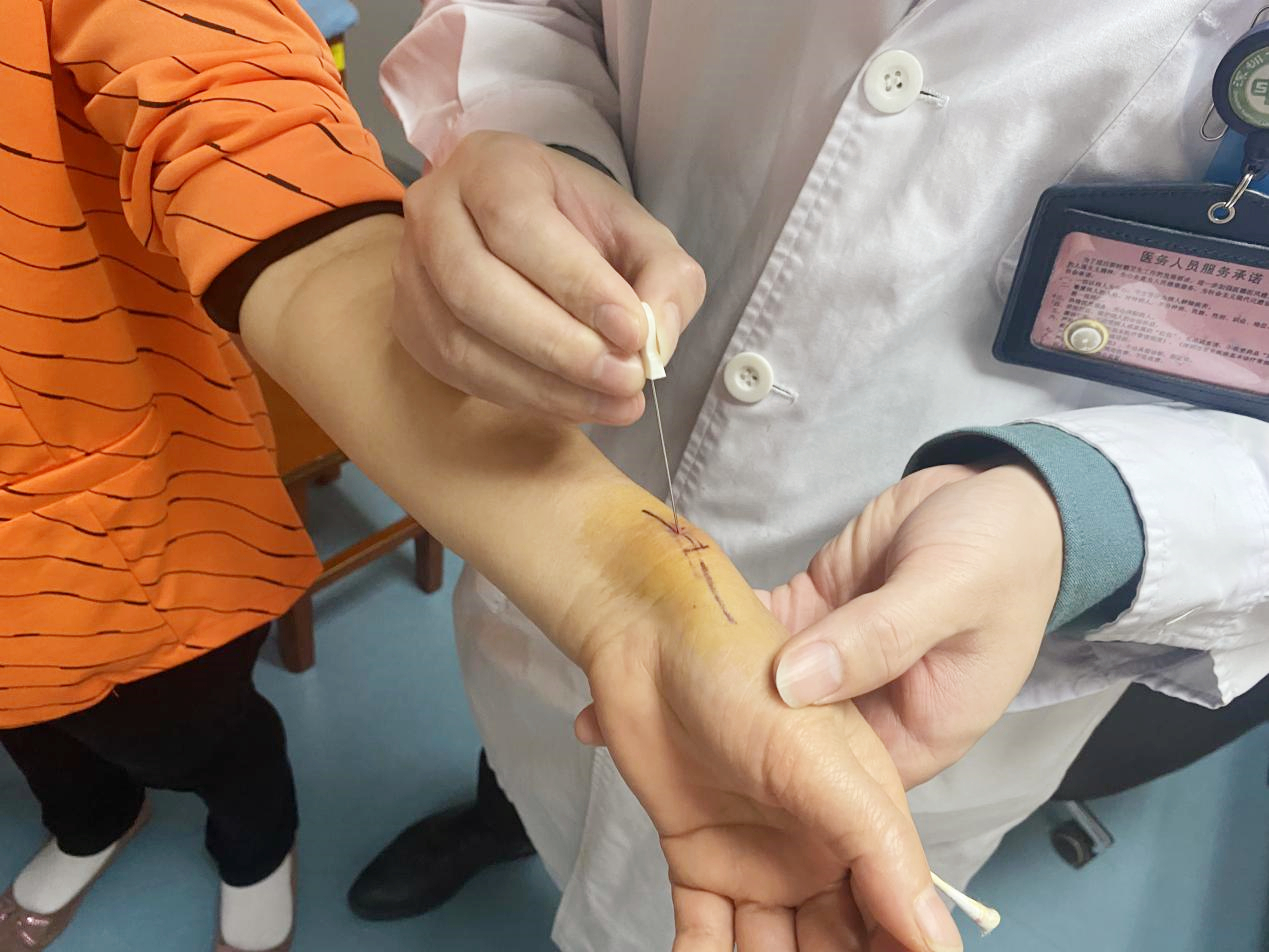 小针刀治疗